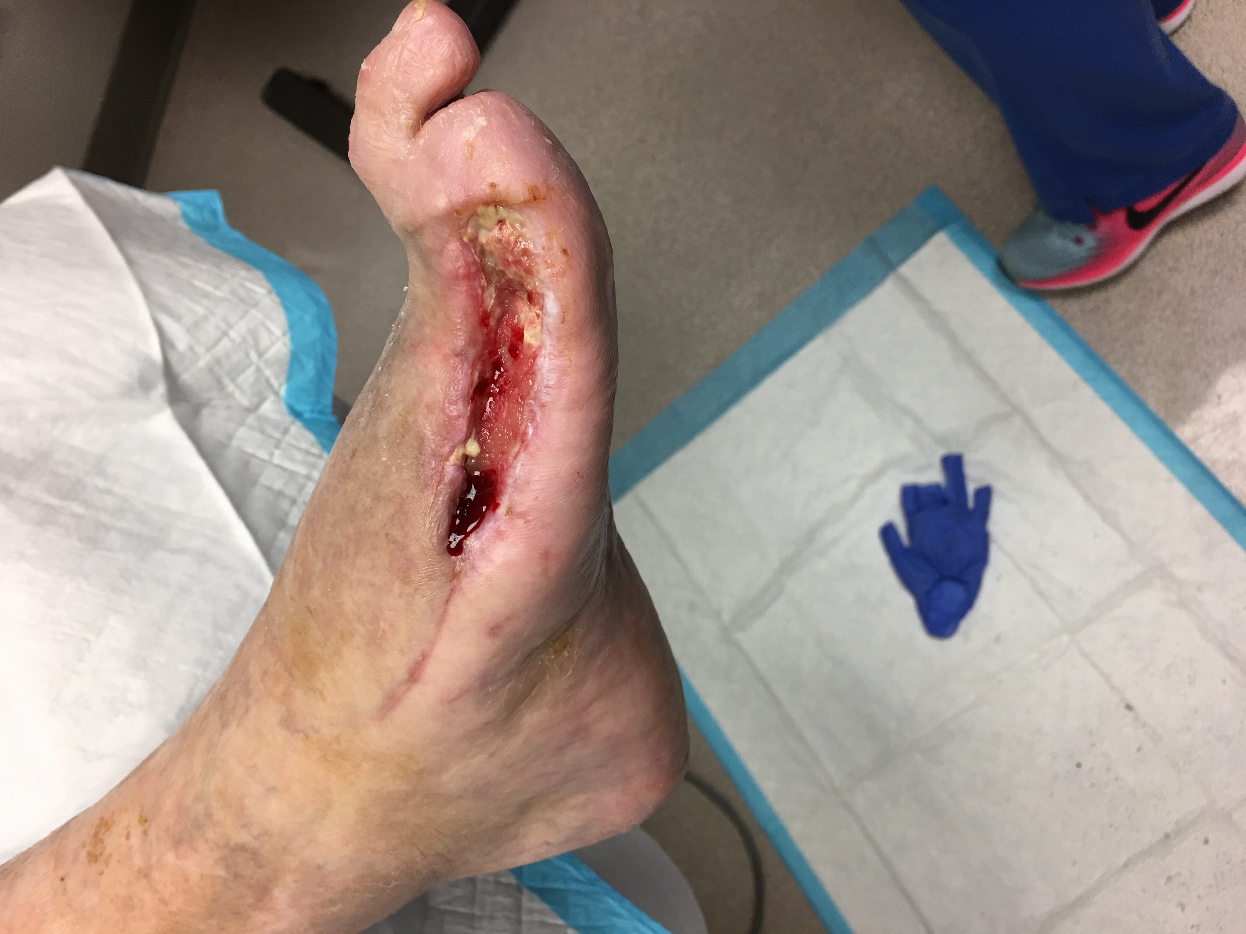 Surgical wound nearing closure
